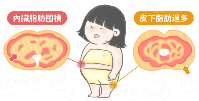 內臟脂肪為代謝症候群的指標 內臟脂肪和皮下脂肪v2