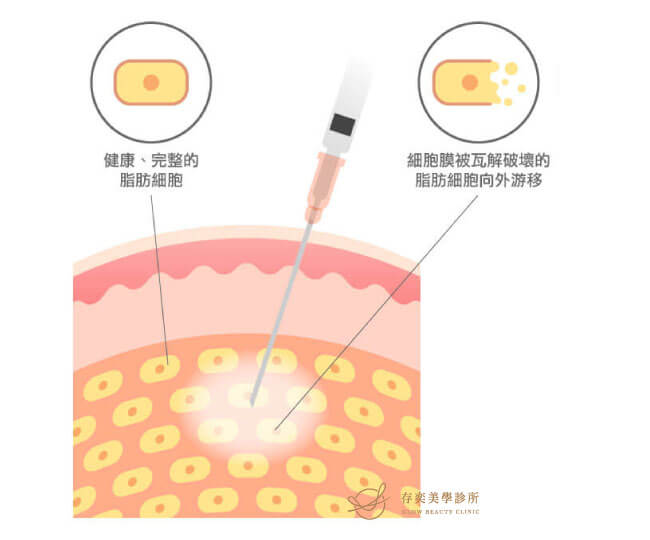 消脂點滴(燃脂點滴,瘦瘦點滴)治療原理瓦解脂肪細胞