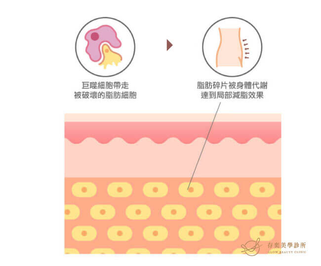 消脂點滴(燃脂點滴,瘦瘦點滴)治療原理脂肪細胞碎片被代謝達到局部減脂