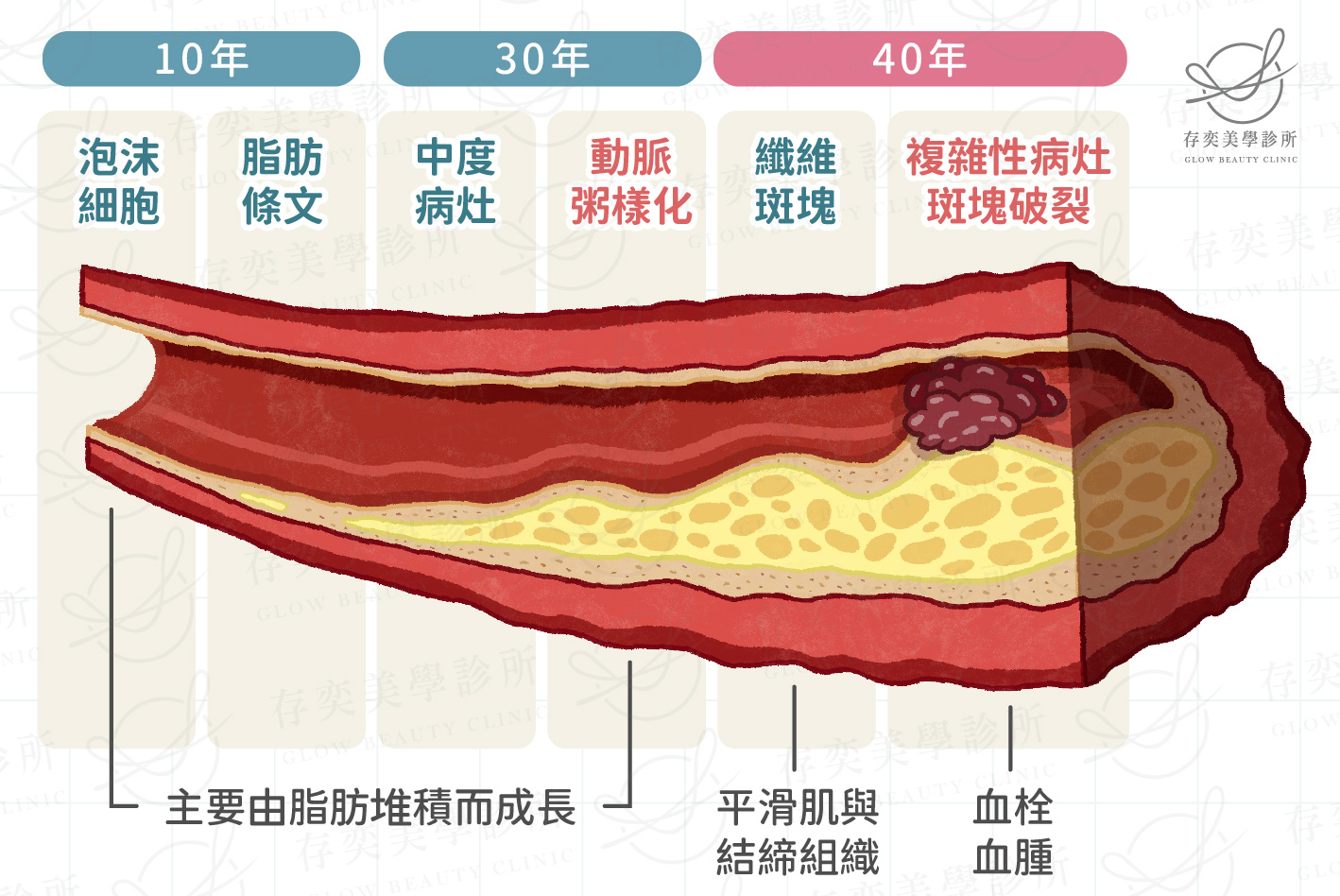 粥狀動脈硬化時程_工作區域 1