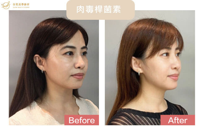 肉毒桿菌素注射除皺瘦臉治療案例注射後效果約可持續4~6個月可依醫師建議定期施打維持效果