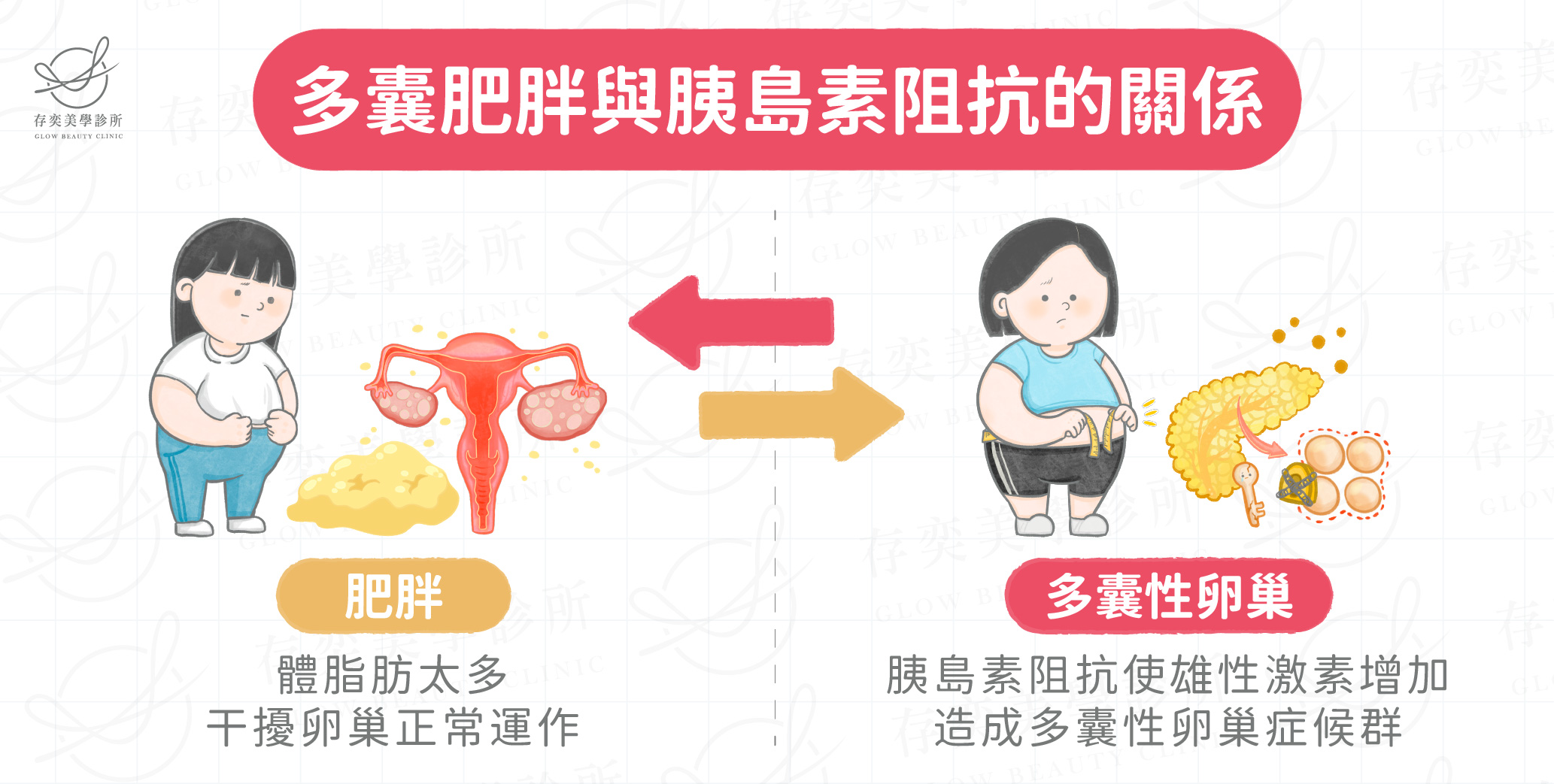 肥胖併發症-多囊性卵巢症候群-01