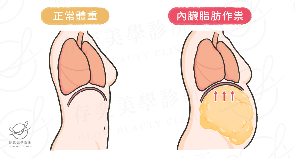肥胖併發症-肺部疾病_內臟