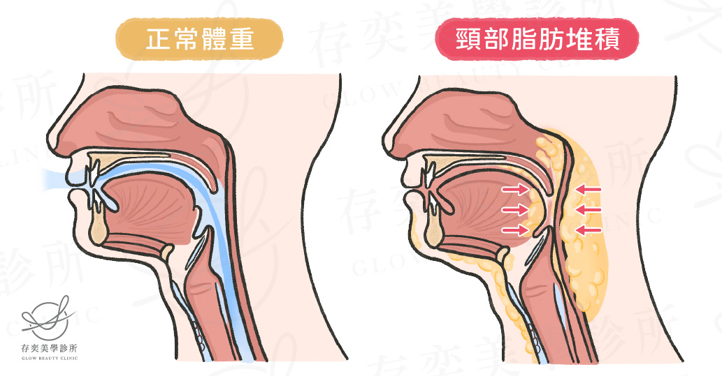 肥胖併發症-肺部疾病_頸部