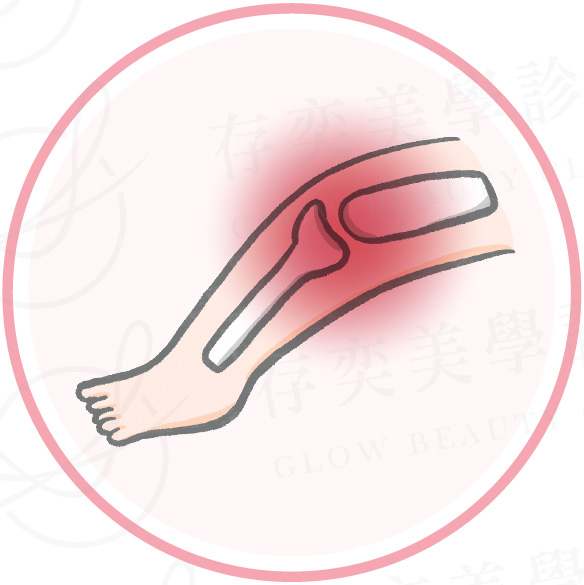 肥胖併發症_關節炎