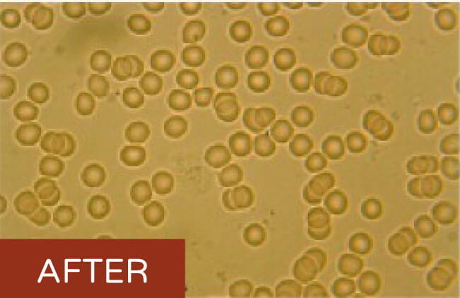 靜脈雷射光療ILIB氦氖雷射同時也會使紅血球改變形狀順利通過細小微血管