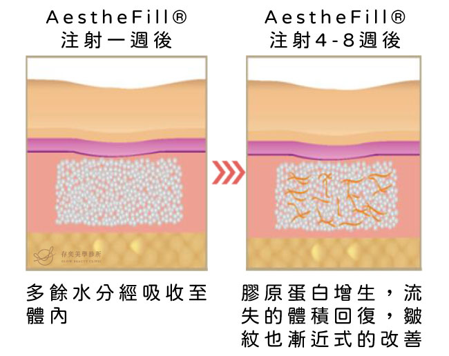 AestheFill®艾麗斯聚雙旋乳酸精靈針-刺激膠原蛋白增生產生立即的填充效果，等待4-8週開始聚雙旋乳酸成分會促進膠原蛋白的增生促進肌膚彈性恢復臉部豐盈飽滿