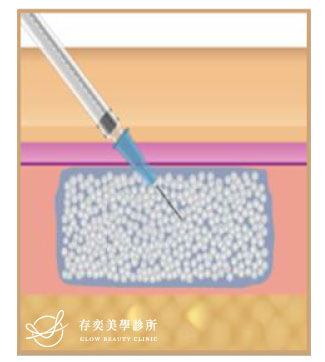 AestheFill®艾麗斯聚雙旋乳酸精靈針-注射後透過發炎反應刺激膠原蛋白增生能立即取代肌膚流失的膠原蛋白的空洞產生立即的填充效果