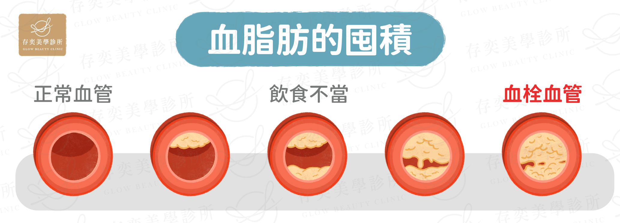 ILIB血脂肪的囤積_工作區域 1