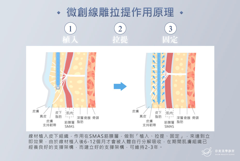 微創線雕拉提(埋線拉提)的線材植入⽪下組織,作⽤在SMAS筋膜層,做到「植入、拉提、固定」,來達到拉提立即效果 4LINE_