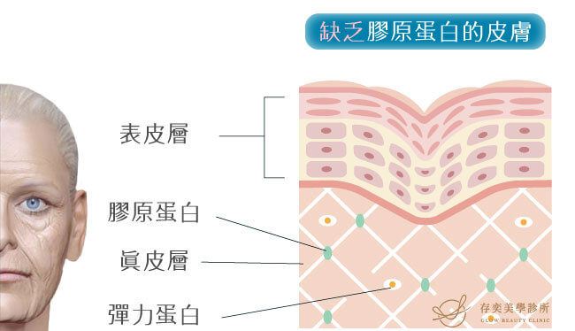 晶亮瓷微晶瓷Radiesse可用於老化產生的皺紋法令紋改善可激活膠原蛋白及彈力蛋白新生改善肌膚彈性又能迅速填補拉提