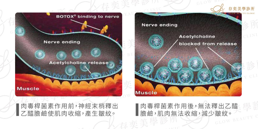 肉毒桿菌素注射除皺瘦臉-003-1129