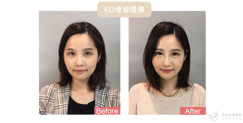 6D埋線隆鼻(線雕隆鼻) 提美拉MIRACLE THREAD許可證 156D