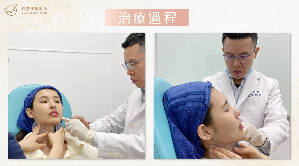 存奕美學診所周建存院長-玻尿酸注射案例分享-玻尿酸豐唇,將玻尿酸注射於唇部進行填補,達到豐盈飽滿的效果 玻尿酸豐唇03