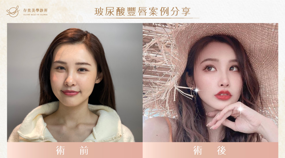 存奕美學診所周建存院長-玻尿酸注射案例分享-玻尿酸豐唇,將玻尿酸注射於唇部進行填補,達到豐盈飽滿的效果 玻尿酸豐唇05