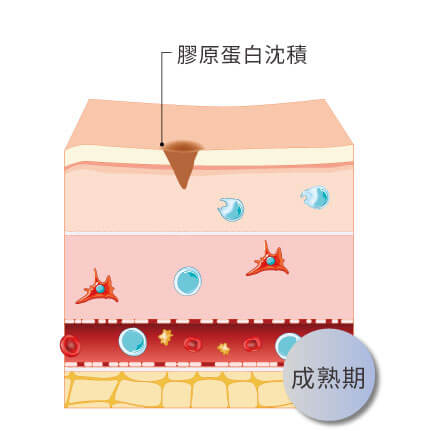 微點飛針重建三大生化程序成熟期纖維母細胞促使結締組織填充在纖維和細胞之間讓新生膠原蛋白結構變得緻密修復原本疤痕逐漸變淡斑點由深變淺