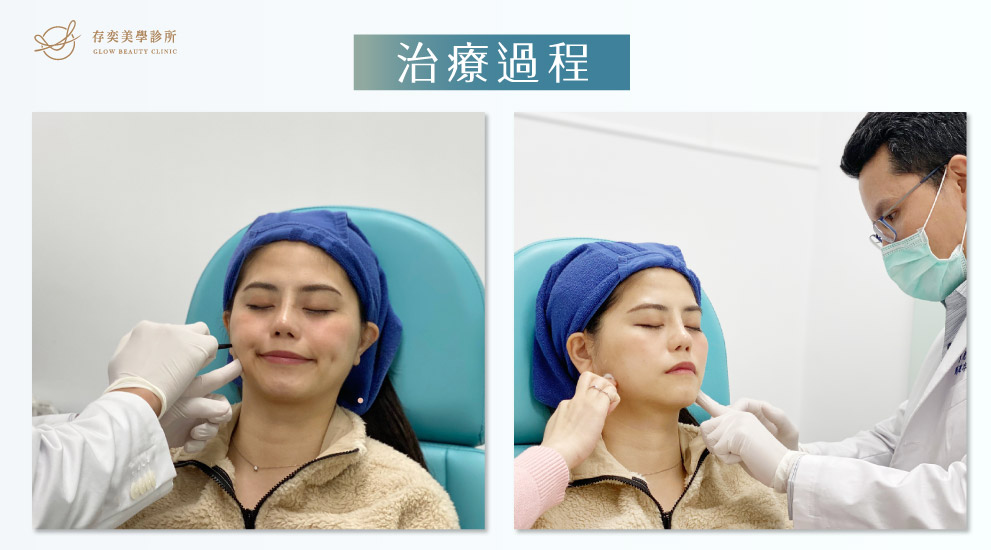 存奕美學診所周建存院長-肉毒桿菌素肉毒瘦小臉案例 肉毒小臉拉提莊莊03