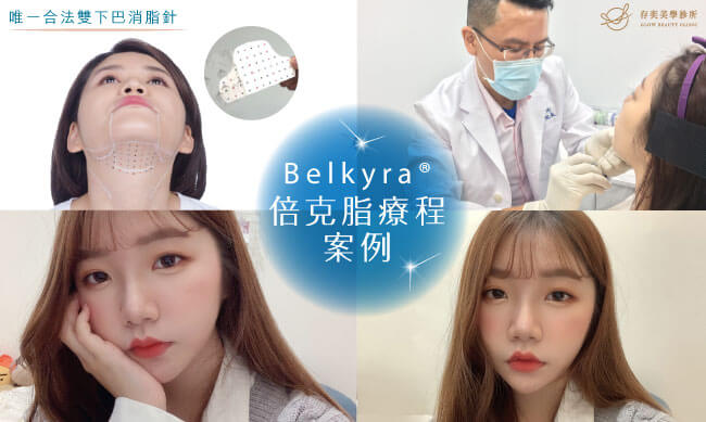 Belkyra®倍克脂消脂針療程案例會使用轉印貼紙進行標記後注射改善頦下脂肪堆積呈現自然明顯的下顎輪廓線