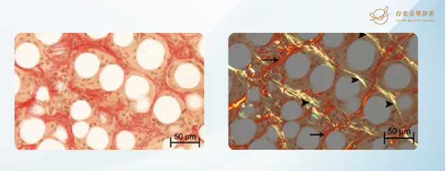 洢蓮絲Ellanse顯微照相顯示第一型的成熟膠原蛋白明顯增生