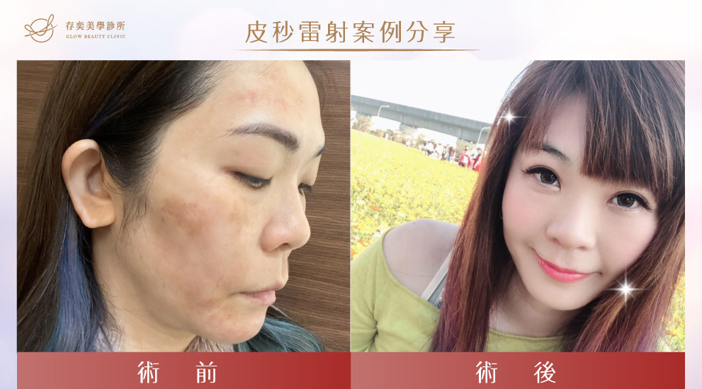 我完整的紀錄了在存奕美學診所施打皮秒雷射前跟施打後的樣子,果然沒有比較沒有傷害,施打前周建存院長有特別說明,治療肝斑所用的皮秒雷射能量不能太強,否則會過度破壞容易反黑,只能盡量淡化。 皮秒雷射怡芳06
