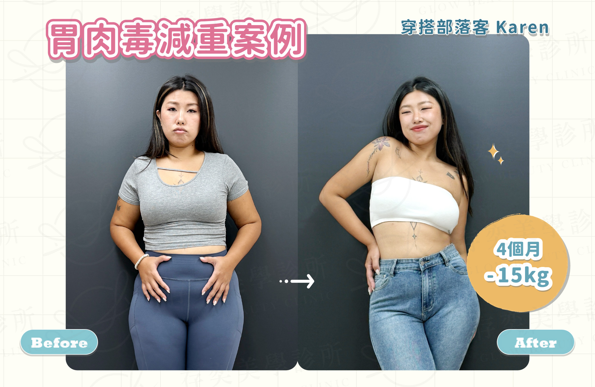胃肉毒案例2_穿搭部落客Karen-1