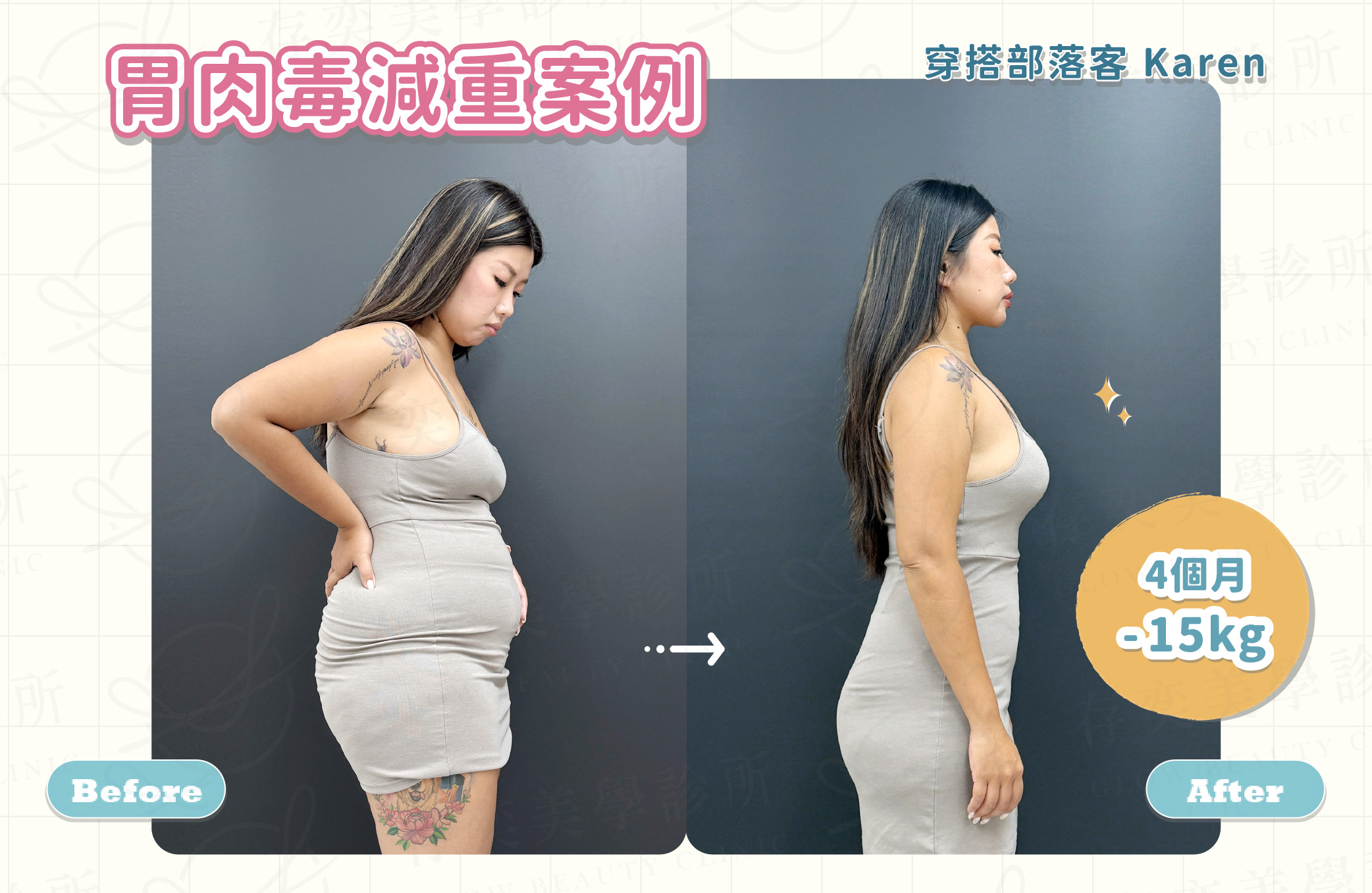 胃肉毒案例2_穿搭部落客Karen-2