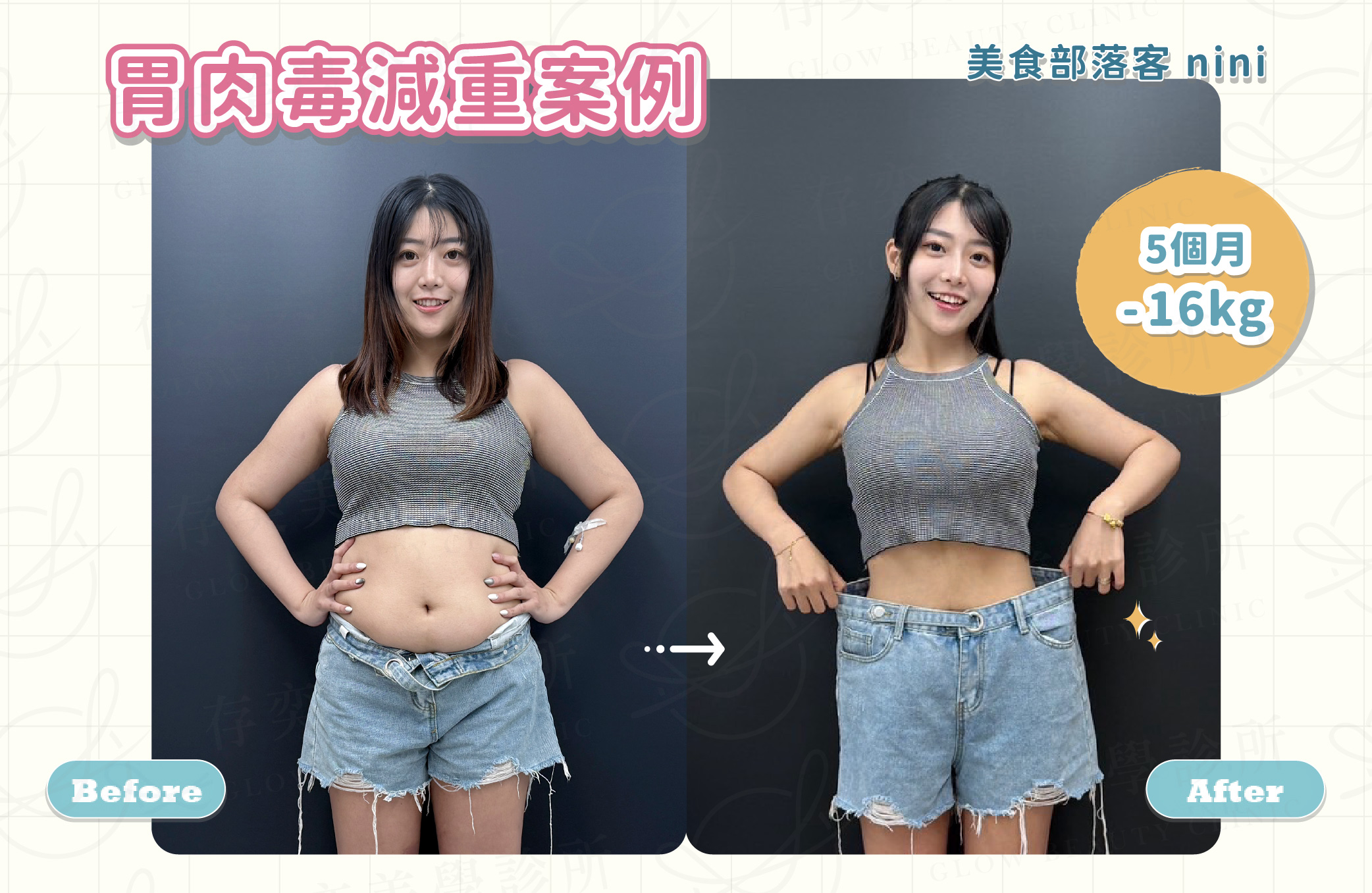 胃肉毒案例2_美食部落客nini-1