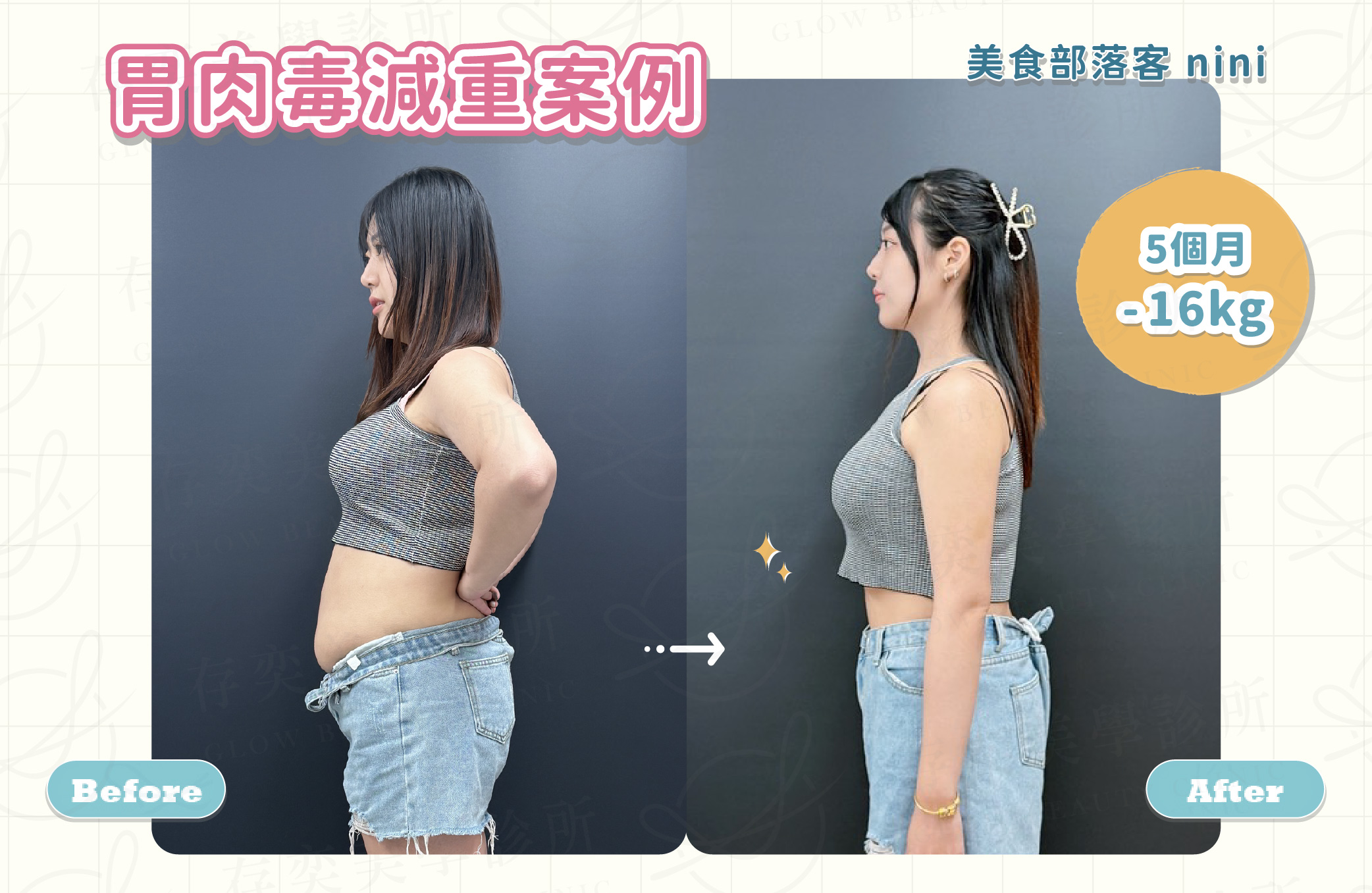 胃肉毒案例2_美食部落客nini-2