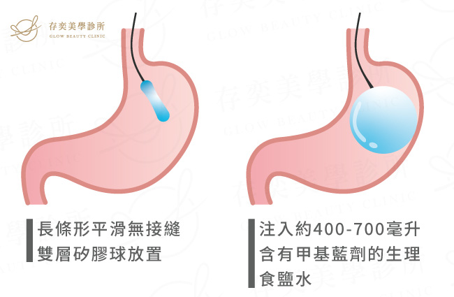 胃鏡減重-胃水球治療原理-1131113