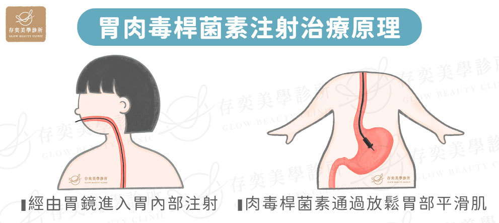 胃肉毒桿菌注射治療原理-2