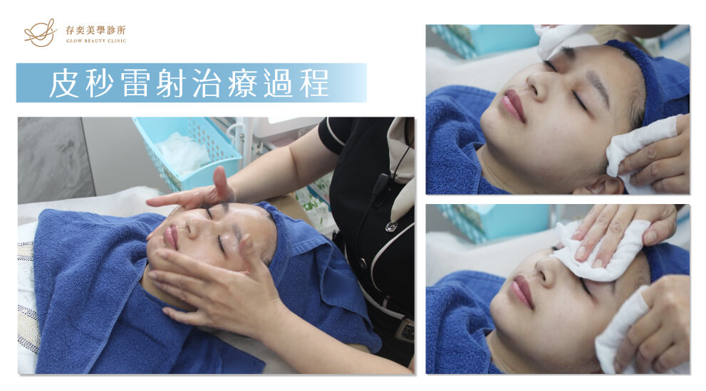 皮秒雷射治療過程_皮秒雷射前需要卸妝洗臉敷麻