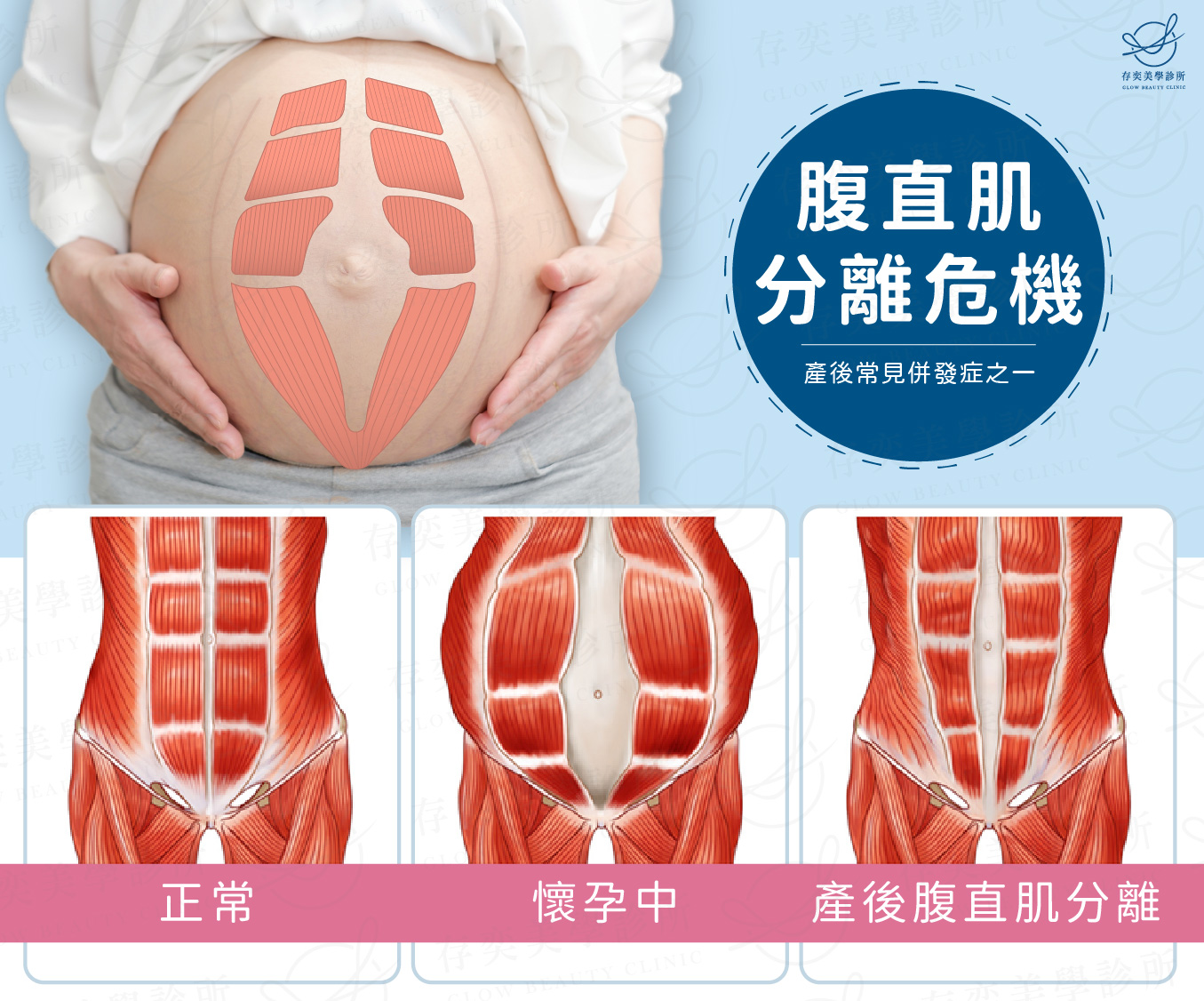 腹直肌分離危機-產後常見併發症_工作區域2