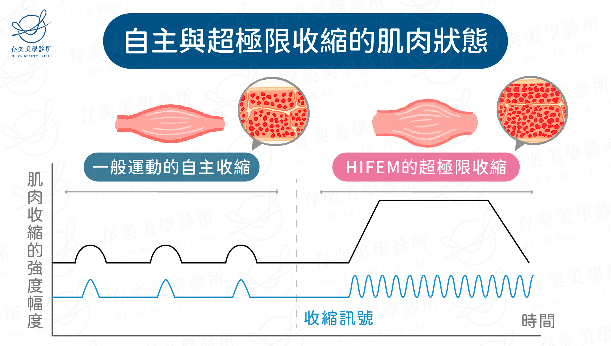 自主與超極限收縮的肌肉狀態2_工作區域 1