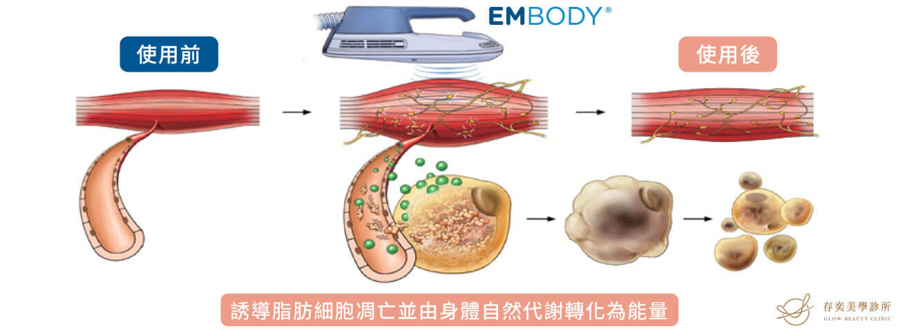 EMBODY核心美力增肌減脂醫美療程_減脂原理誘發脂肪凋亡進入粒線體由身體自然代謝轉化為能量