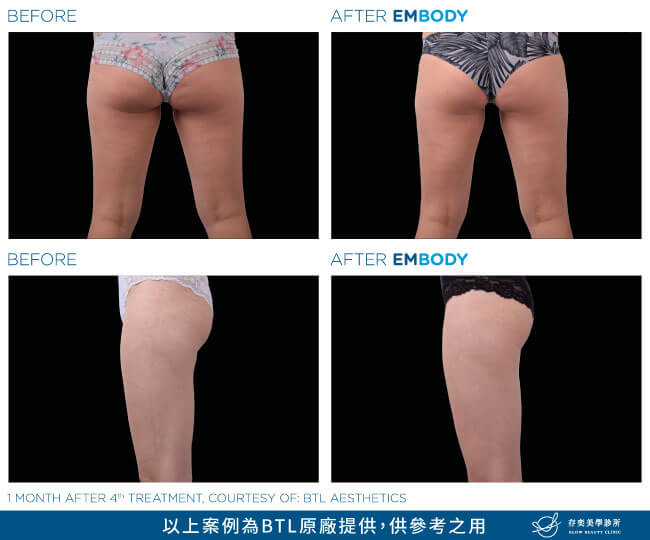 EMBODY核心美力增肌減脂醫美療程_臀部治療臀大肌臀中肌改善臀部扁垮鬆弛