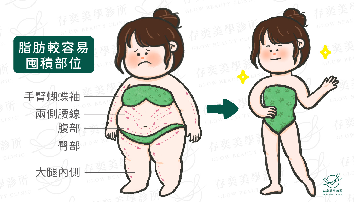 傳統抽脂手術治療特點-瘦身效果明顯v2-02