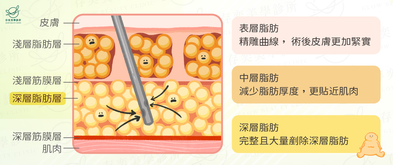 傳統抽脂手術治療特點-解決深層脂肪問題v2-02