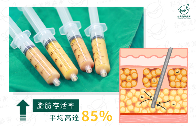 威塑抽脂手術抽出的脂肪存活率平均高達85%v2