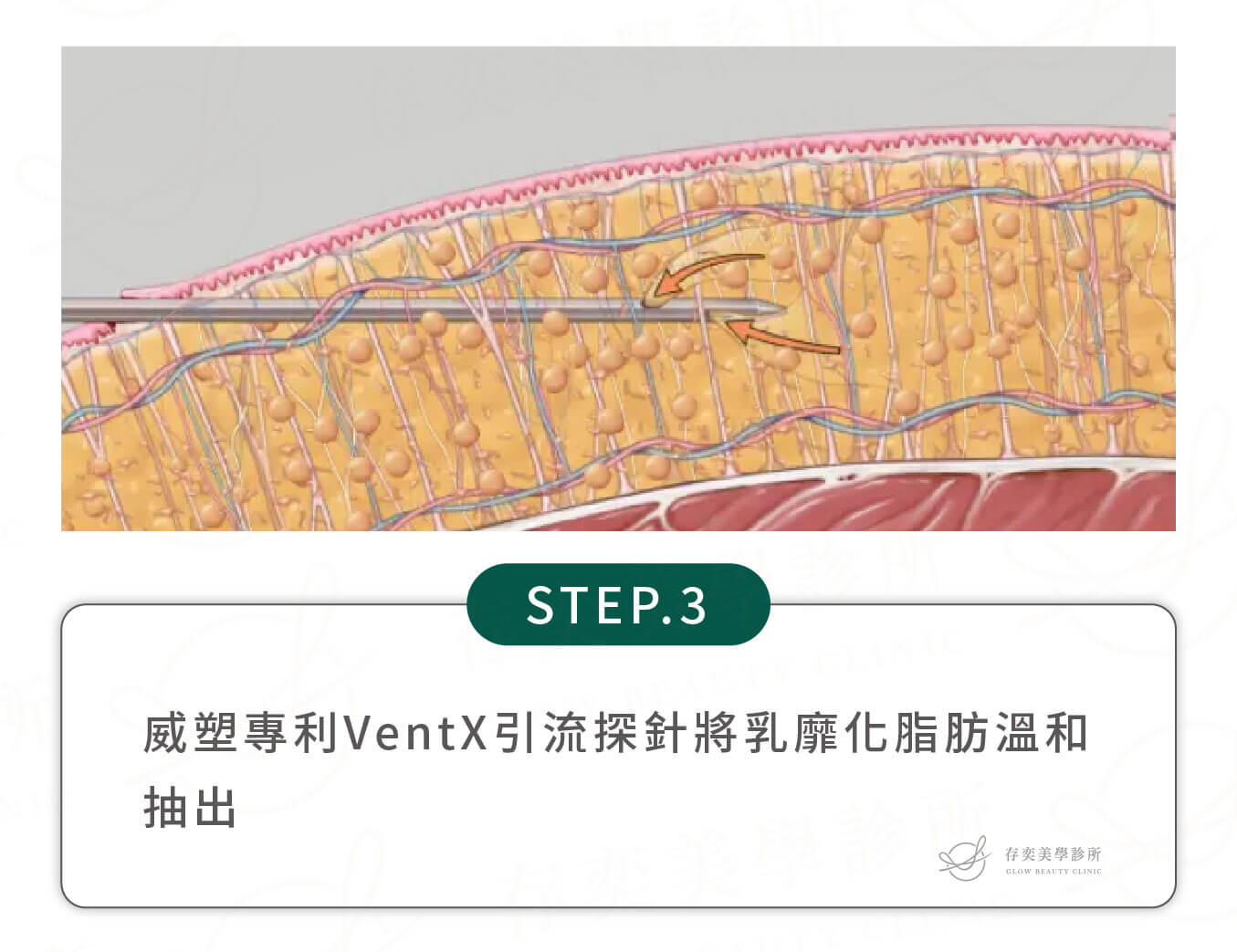 威塑抽脂手術除脂步驟_專利VentX引流探針將乳靡化脂肪溫和抽出