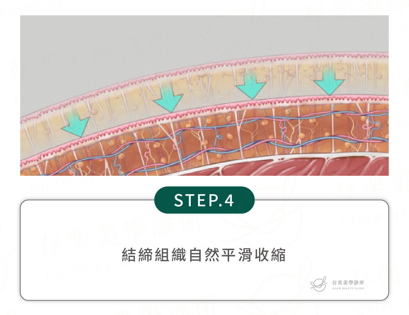 威塑抽脂手術除脂步驟_結締組織自然平滑收縮