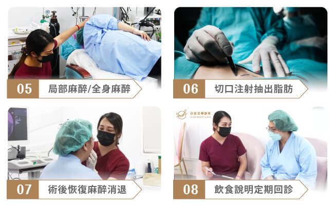 存奕美學診所傳統抽脂手術治療流程-2