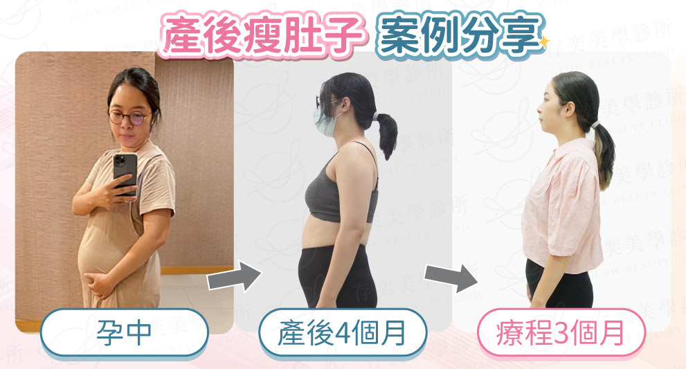非常多產後媽媽是合併鬆弛、脂肪及腹肌分離問題,像是個案芷芷產後四個月肚子仍消不下去,透過全方位科學減重諮詢過程,周建存醫師客製化增肌減脂減重菜單,生活作息調整、腹肌運動重訓建議,制定了完整的減重計畫。不只是減重瘦肚子,更成功增肌減脂,體脂肪率降5%,肌肉量提升,體態曲線變好,體能也明顯改善。 圖BA-產後案例分享