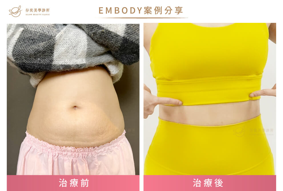 產後瘦肚子-EMBODY案例