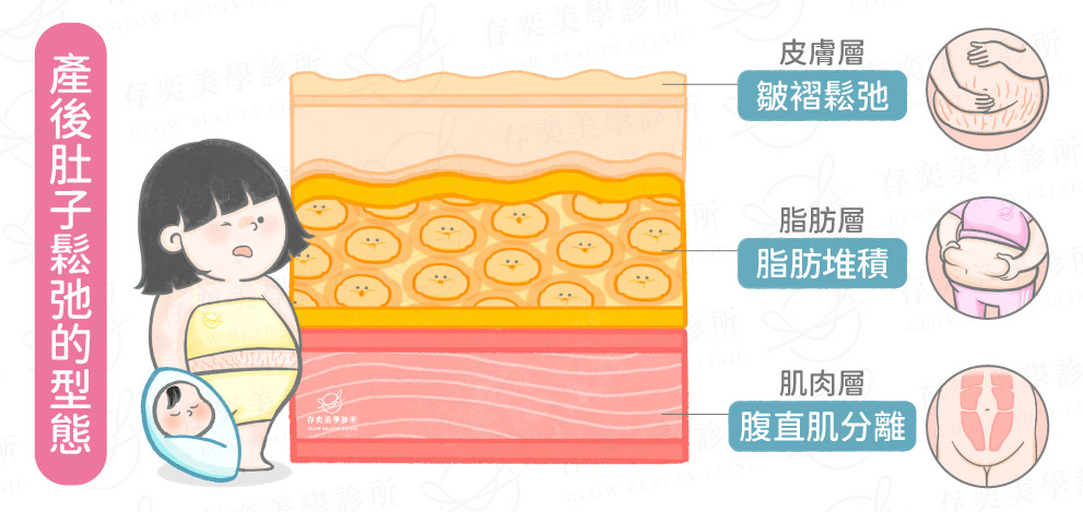 產後肚子鬆弛的型態包含皮膚鬆弛型、脂肪囤積型、腹肌分離型,可能合併多項出現,並且超過半數媽媽產後有腹直肌分離產後肚子鬆弛問題,若腹直肌長期分離,鬆弛的腹部會形成更多脂肪囤積的空間,使得小腹越來越凸出,並加劇腰背疼痛問題。 產後肚子鬆弛3大型態