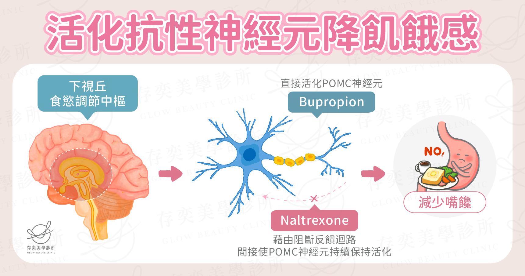 康纖芙特點活化抗性神經元降低飢餓感,康纖芙的Buproion HCl成分可增加POMC神經元活性,Naltrexone HCl成分可維持POMC神經元活性。幫助用餐後,POMC神經元快速傳達停止進食的飽腹感信號,達到抑制食慾、降低飢餓感的效果。 康纖芙活化抗性神經元降機飢餓感v2