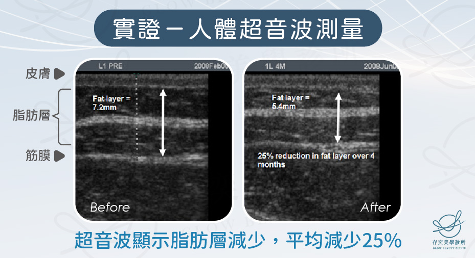 酷塑冷凍減脂實證－人體超音波測量2_0