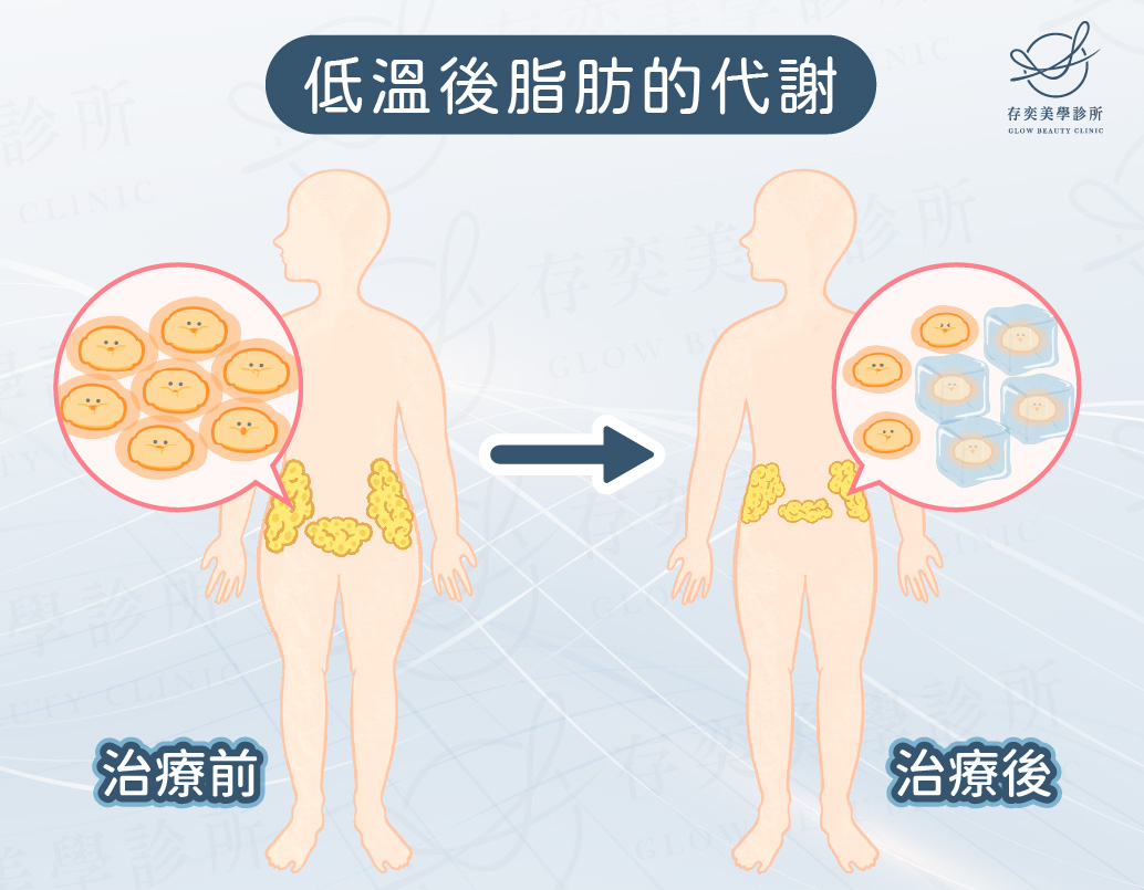 酷塑冷凍減脂是什麼3_工作區域 1