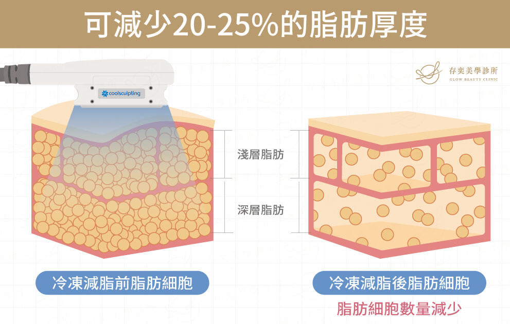 冷凍減脂效果如何_平均單次療程可減少25％的脂肪層厚度