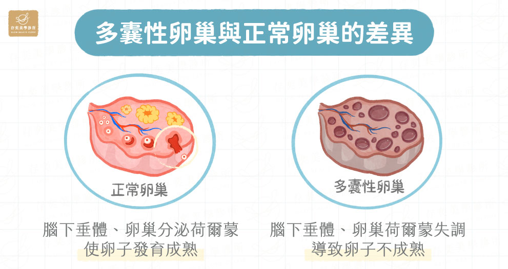 什麼是多囊性卵巢_多囊性卵巢與正常卵巢的差異-5