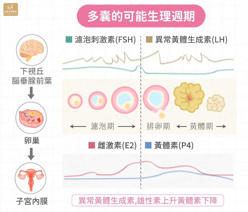 月經期間荷爾蒙變化_慢性不排卵會造成黃體素不足_多囊